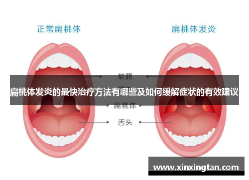 扁桃体发炎的最快治疗方法有哪些及如何缓解症状的有效建议