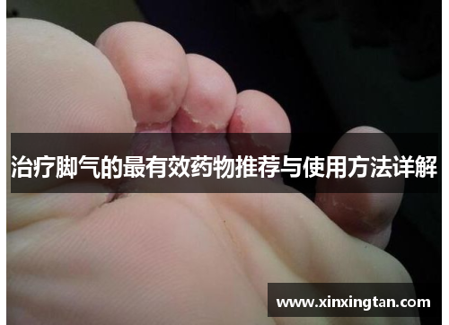 治疗脚气的最有效药物推荐与使用方法详解