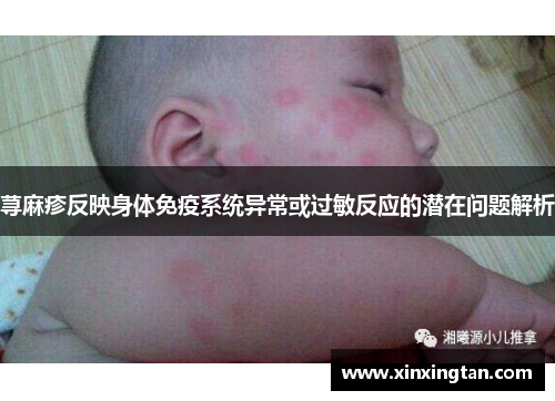 荨麻疹反映身体免疫系统异常或过敏反应的潜在问题解析