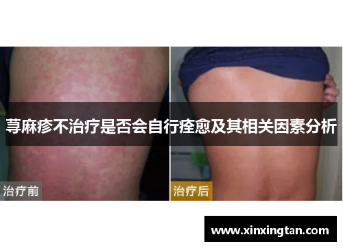 荨麻疹不治疗是否会自行痊愈及其相关因素分析